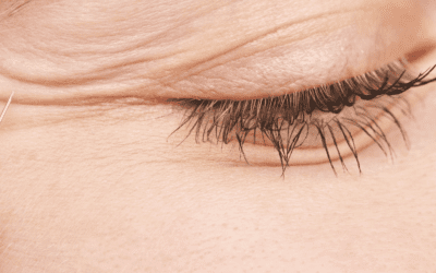 The Most Effective Ways To Defeat Crow’s Feet – At Home Or At Your Favourite Clinic!