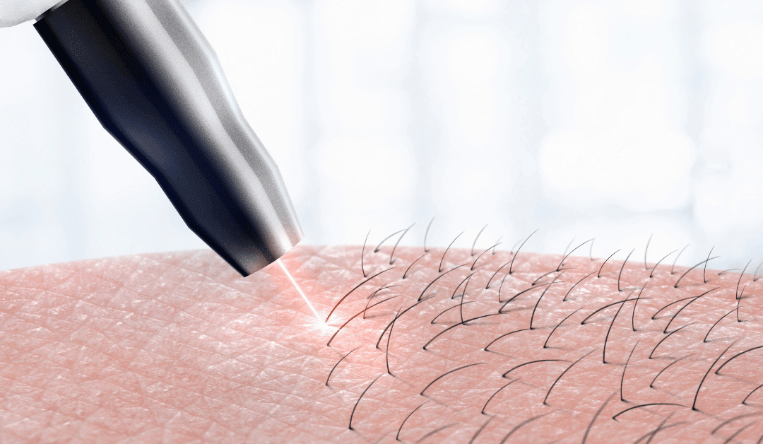 សេវាជម្រុះរោមដោយកាំរស្មីឡាស៊ែរ៖ តើវាមានលក្ខណៈយ៉ាងដូចម្តេច? (បទពិសោធជោគជ័យរបស់អតិថិជន)