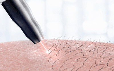 Laser Hair Removal – What’s it like? (Featuring Client Success Stories)