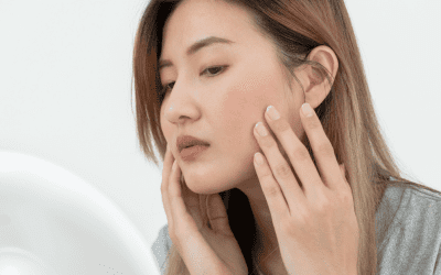 Sick Of Acne Scars? Here’s How You Can Reduce Or Remove Them