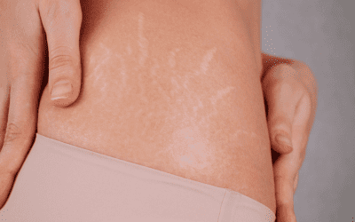 Most Commonly Asked Questions About Stretch Marks Treatment