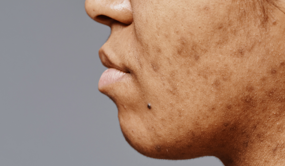 Acne Scars Removal By Fotona SP